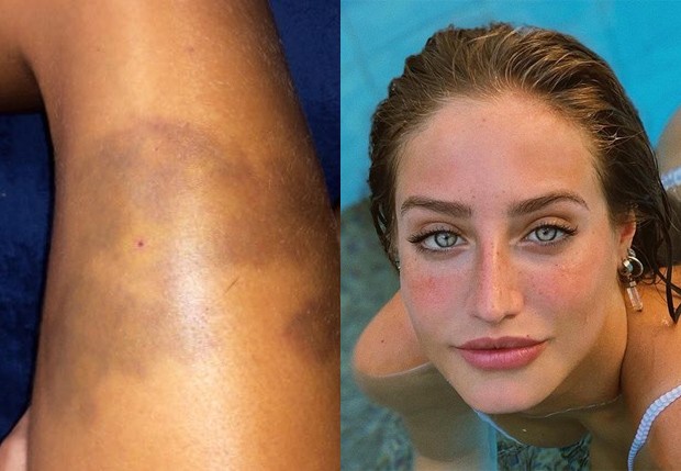 Bruna Griphao mostra hematomas após mordida dfe cachorro (Foto: Reprodução/Instagram)