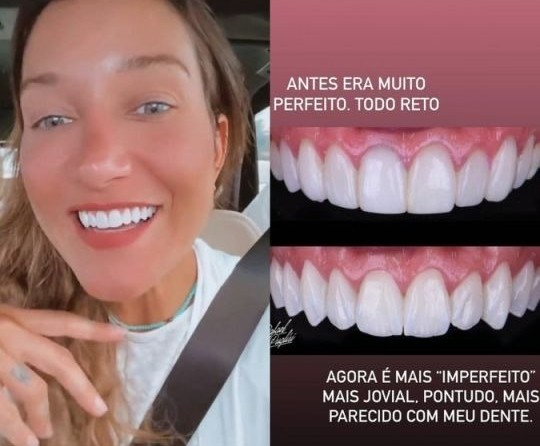 O antes e depois das lentes de contato dentais da influencer Gabriela Pugliesi (Foto: Reprodução / Instagram @rafapuglisi)