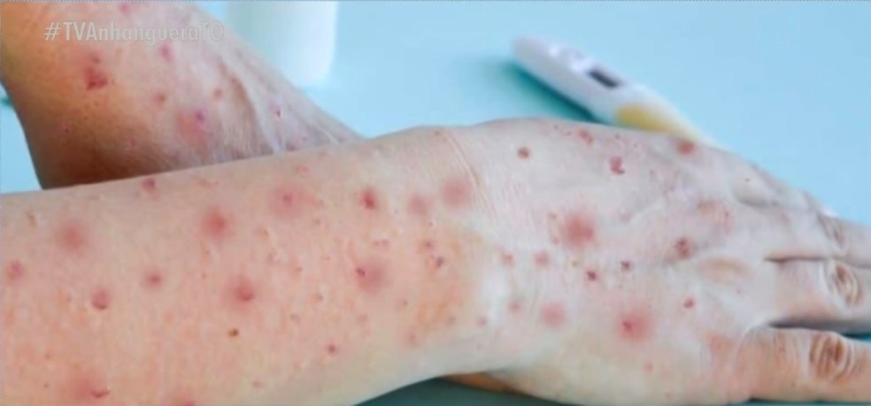 Imagem de pessoa infectada pela varíola dos macacos — Foto: Reprodução/TV Anhanguera