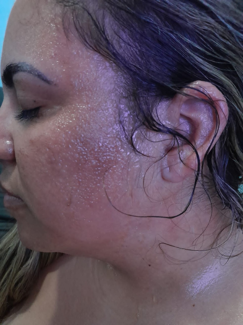 Mulher tem rosto queimado com água quente pelo marido e relata ameaças: "Estou presa em casa" — Foto: Arquivo pessoal