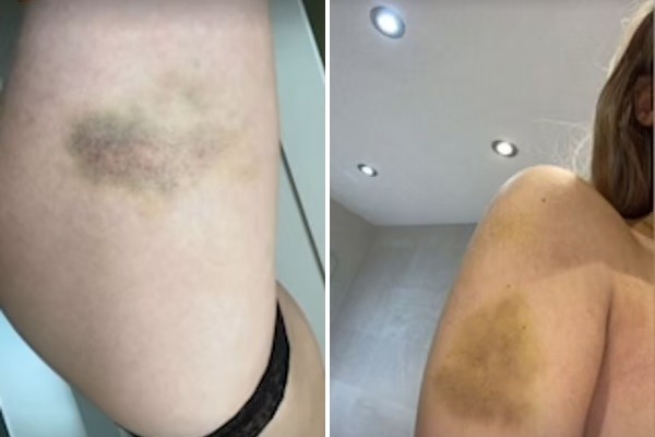 Hematomas espalhados pelo corpo da modelo Harriet Robson, que acusa o namorado por violência doméstica (Foto: Instagram)