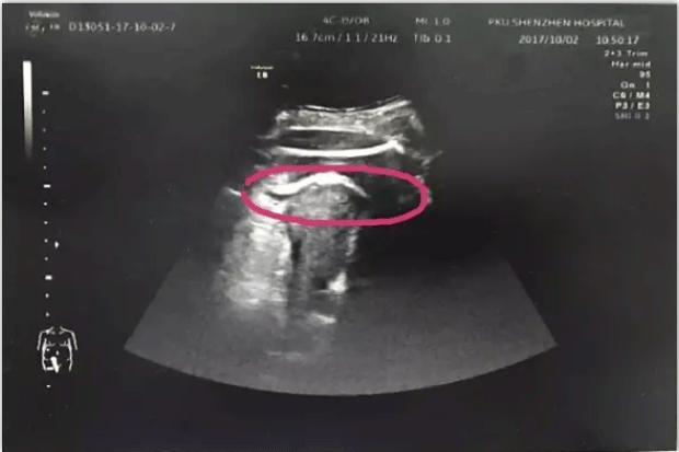Ultrassom mostra rompimento do útero (destaque) (Foto: Reprodução / Weixin)