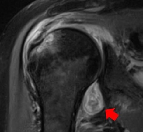 Imagem obtida por ressonância magnética do ombro de um paciente que teve Covid-19 e desenvolveu artrite reumatóide. A seta vermelha aponta para uma inflamação na articulação. (Foto: Northwestern University)