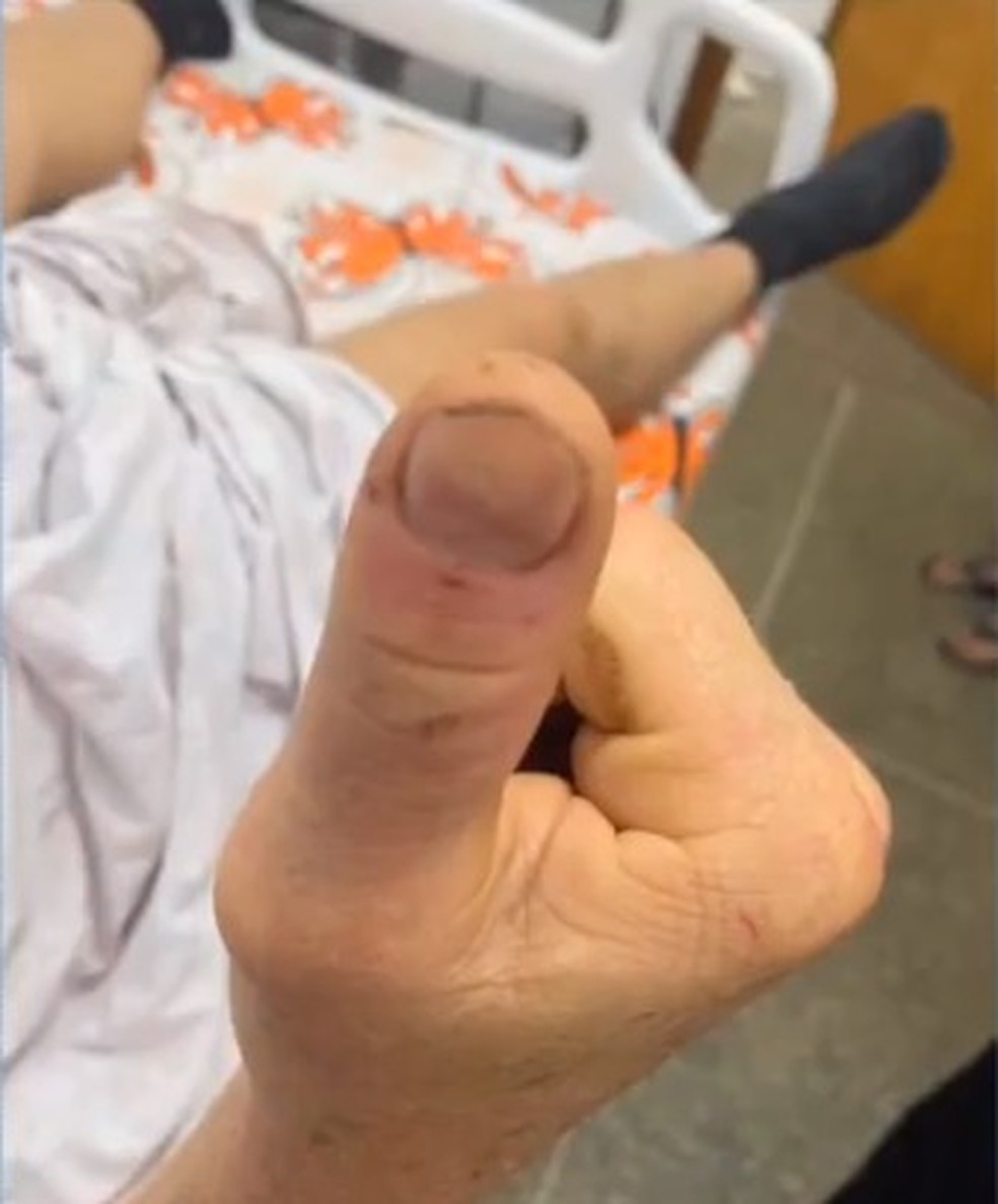 Homem picado por cascavel se recuperou bem após receber soro  — Foto: Arquivo pessoal