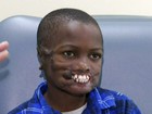 Menino de 8 anos atacado por chimpanzés vai ganhar novos lábios