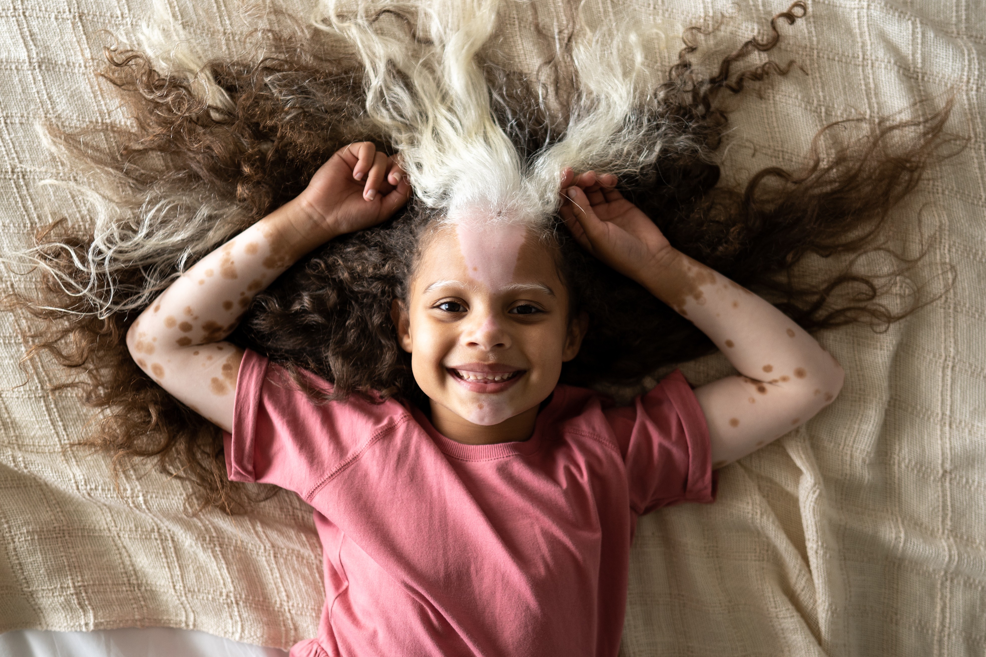 Vitiligo na infância (Foto: Getty)