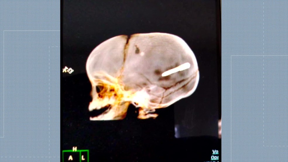 Radiografia mostra prego alojado na cabeça de um bebê de 10 meses — Foto: Reprodução / TV Globo