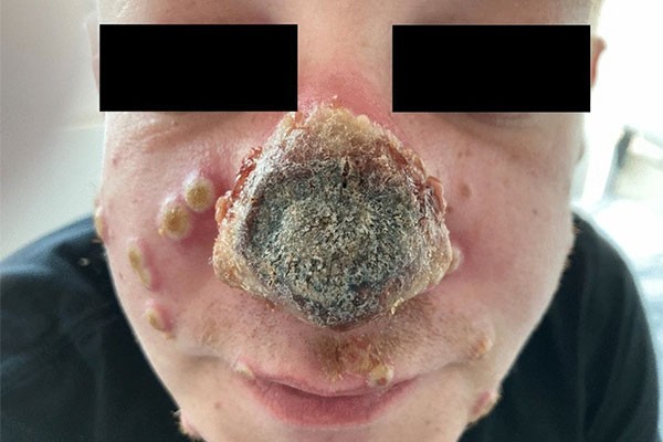 Alemão imunossuprimido que contraiu varíola dos macacos e acabou com o nariz necrosado (Foto: divulgação)