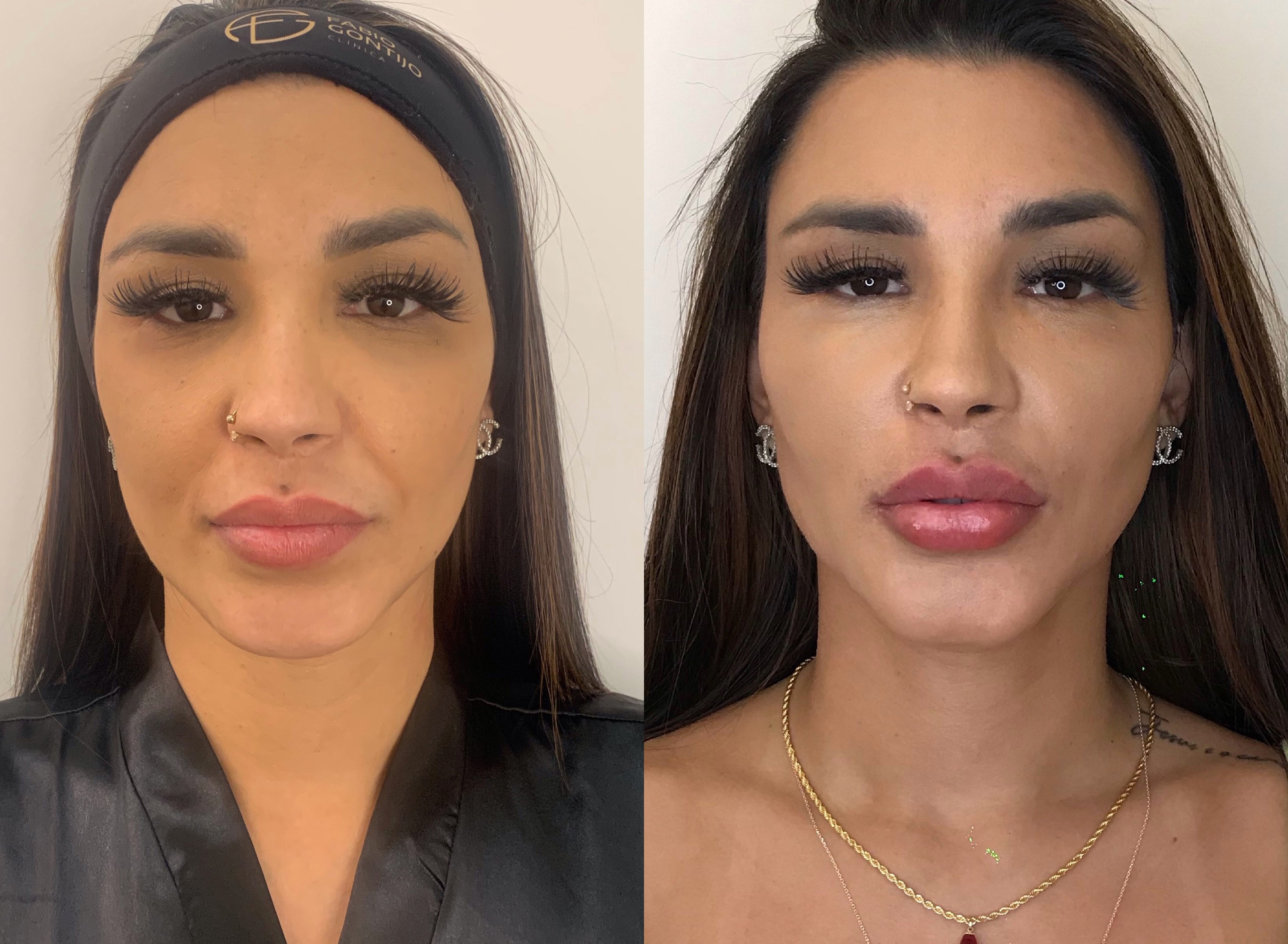 Jenny Miranda mostra antes e depois e harmonização facial feita