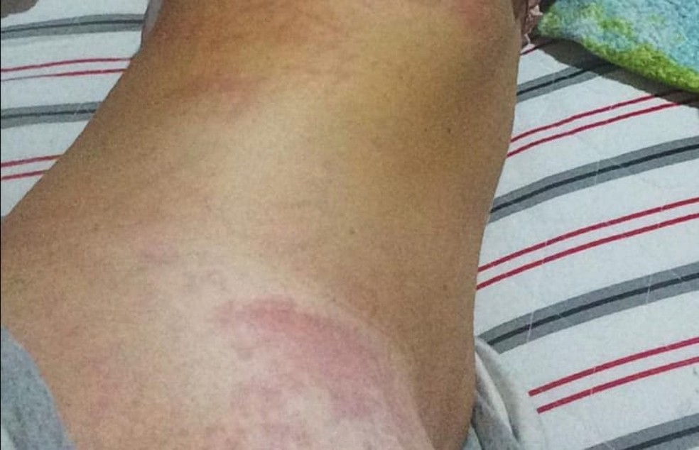 Estudante sofre irritação na pele após ter contato com óleo que atinge as praias do Nordeste — Foto: Arquivo pessoal
