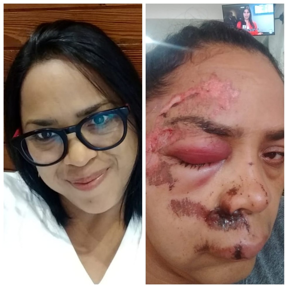 VÃ­tima ficou com rosto todo ferido apÃ³s cair de bicicleta durante assalto em GuarujÃ¡, SP â Foto: Arquivo pessoal 