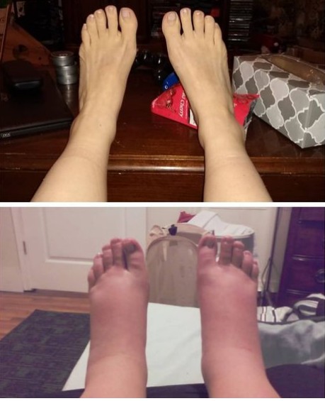 Mãe mostra antes e depois dos pés inchados na gravidez (Foto: Reprodução/Instagram/mindihayz)