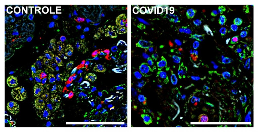 Imagens de imunofluorescência de tecido pulmonar obtido por meio de autópsia – à direita de paciente que morreu por complicações da Covid-19 e à esquerda de falecido por causa não relacionada. A cor azul representa o núcleo das células, a verde um marcador (S1009) de monócitos e macrófagos infiltrados no tecido e a vermelha o receptor CD36. Macrófagos e monócitos que expressam tanto S1009 e CD36 aparecem em amarelo pela sobreposição dos dois (Foto: Alexandre Fabro e Edismauro Freitas-Filho)
