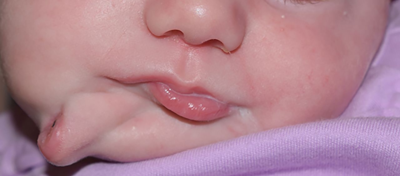 Bebê nasce com duas bocas nos Estados Unidos (Foto: Reprodução / BMJ Reports)