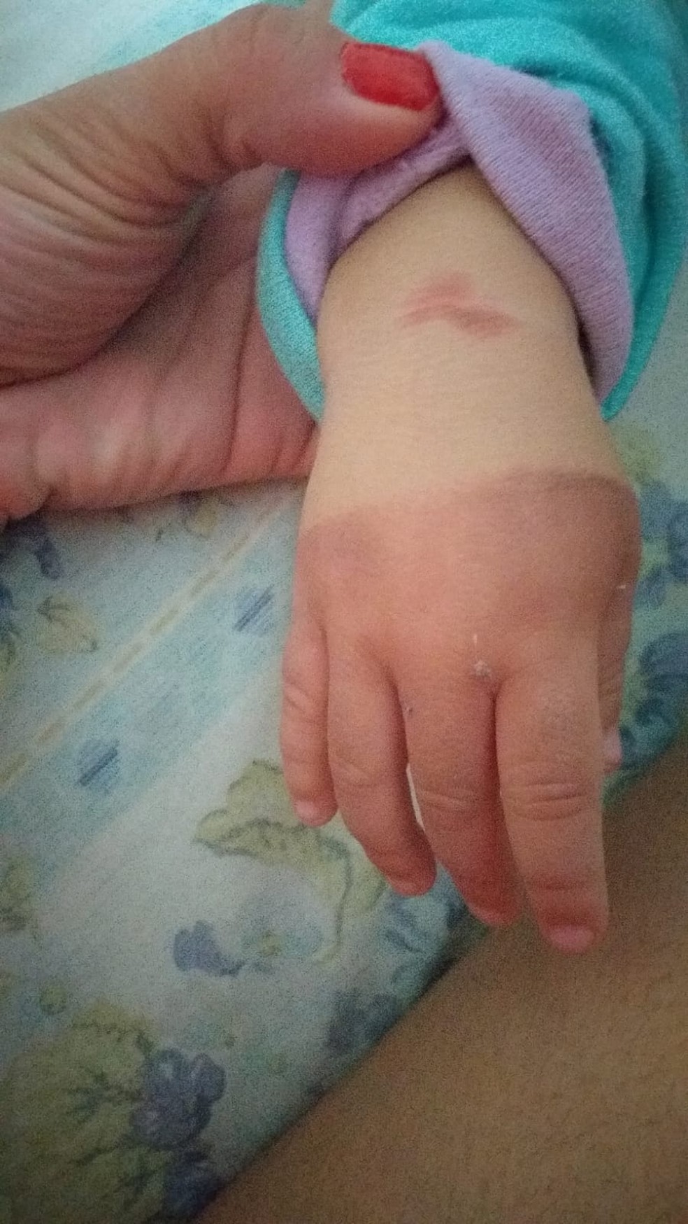 Mãe denuncia babás por maus-tratos após bebê de 1 ano ter mão queimada, em MS