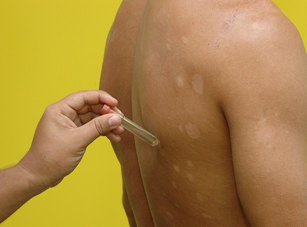 Resultado de imagem para hanseniase