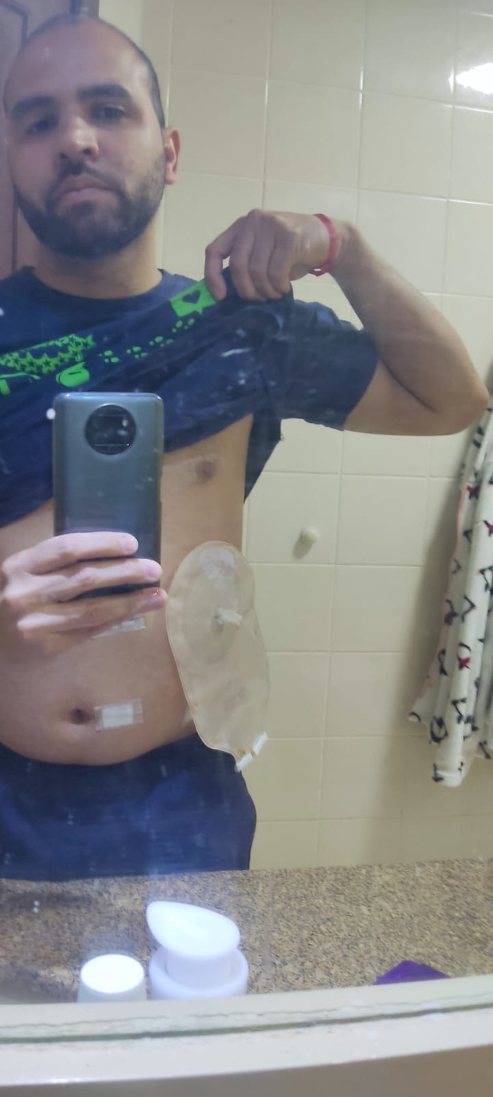 João Carlos trocou a luva por uma bolsa de colostomia por intermédio de uma amiga — Foto: Arquivo pessoal
