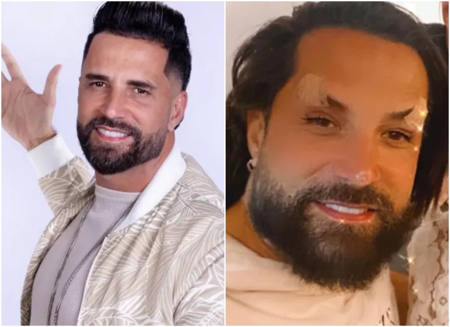 Latino transforma visual com procedimentos estéticos no rosto