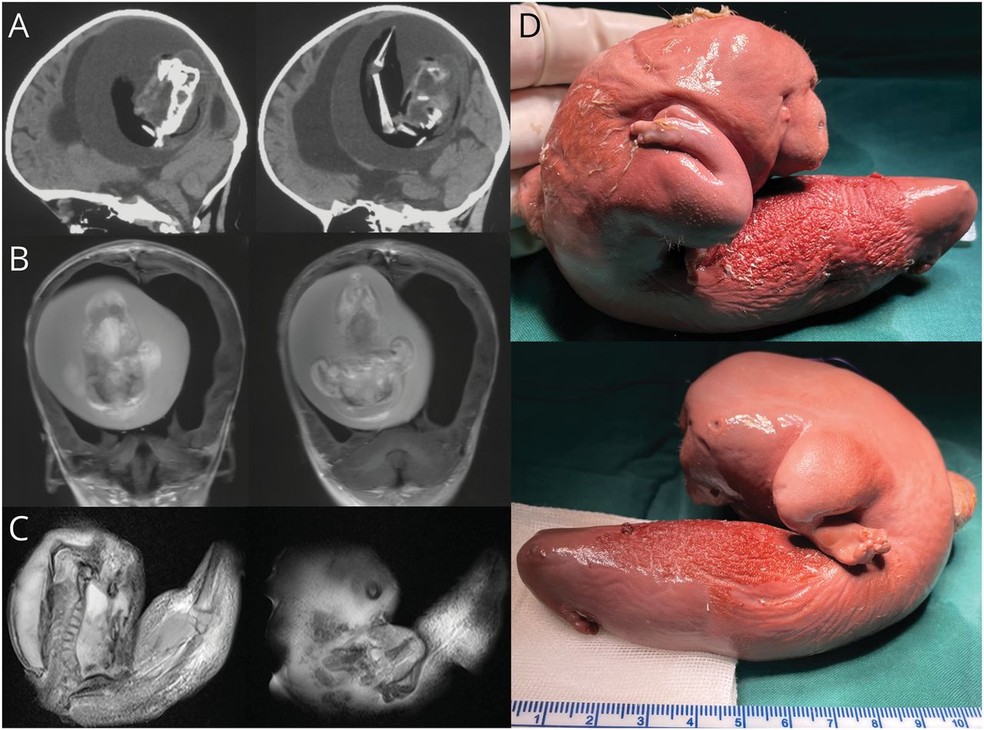 Tomografia computadorizada do crânio da criança com o feto 'gêmeo' — Foto: Zongze Li et.al 