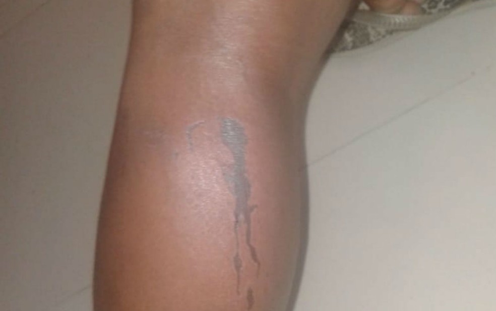 Além do rosto e costas, perna da vítima também foi queimada durante o ataque (Foto: Arquivo pessoal)