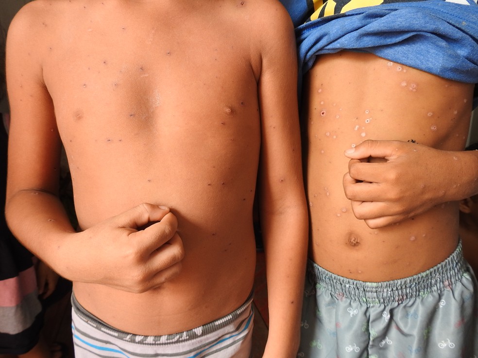 Crianças tem febre, dor de cabeça  e alergia no corpo. Uma delas foi diagnosticada com catapora.  — Foto: Ive Rylo