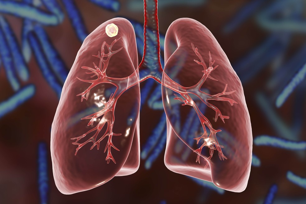 Ilustração mostra a infecção da tuberculose, com nódulo sólido localizado na parte superior do pulmão — Foto: Kateryna Kon/Science Photo Libra/KKO/Science Photo Library/AFP/Arquivo