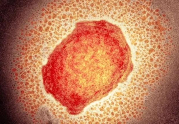 Varíola dos macacos pode ser potencialmente séria. Geralmente, começa com sintomas semelhantes aos da gripe e inchaço dos gânglios linfáticos. Posteriormente, progride para uma erupção disseminada no rosto e no corpo (Foto: SCIENCE PHOTO LIBRARY via BBC)