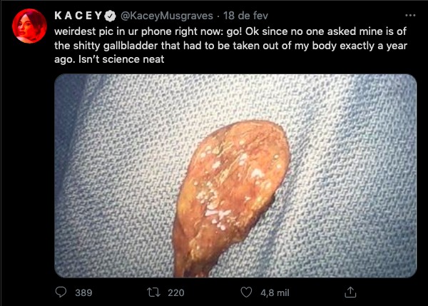 O tuíte da cantora Kacey Musgraves com a foto de sua vesícula biliar (Foto: Twitter)