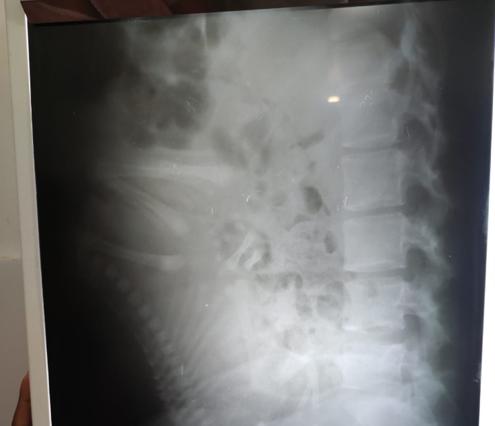 Jovem vai ao médico com dores nas costas e descobre estar grávida através de exame de raio-x na BA — Foto: Arquivo Pessoal
