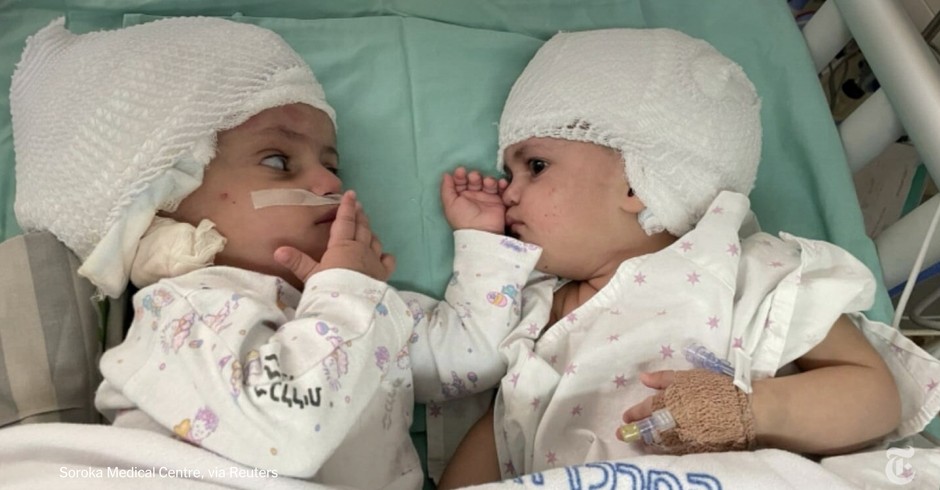 As gêmeas foram separadas depois de 12 horas de cirurgia (Foto: Reprodução/N12)