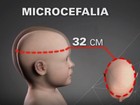 Em novo boletim, casos suspeitos de microcefalia aumentam no Sertão 