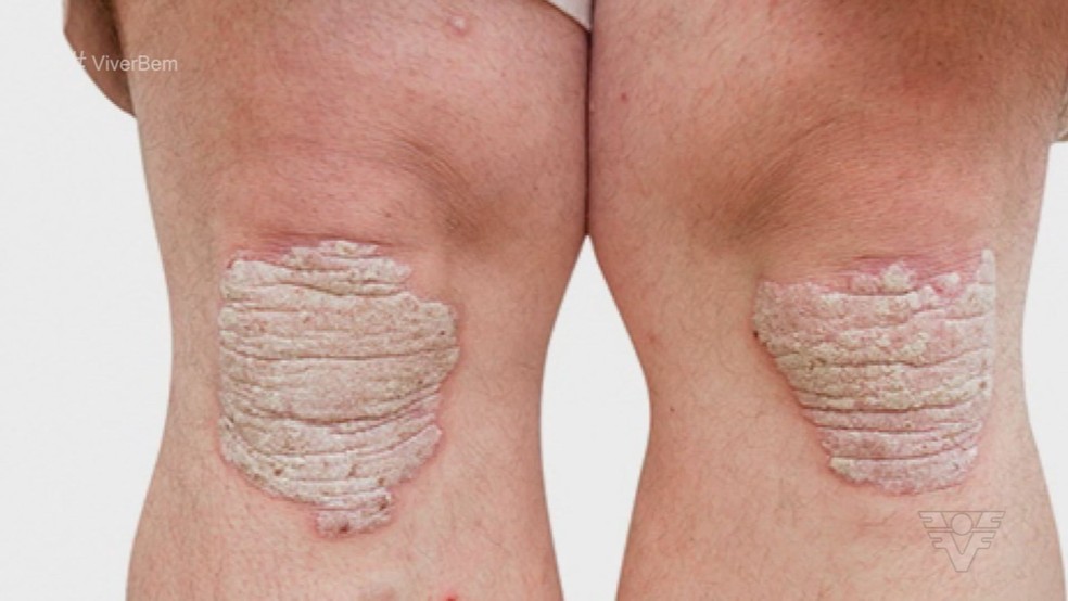 Psoriase E Uma Doenca Nao Transmissivel Mas Ainda Cercada De Preconceito Mais Saude G1