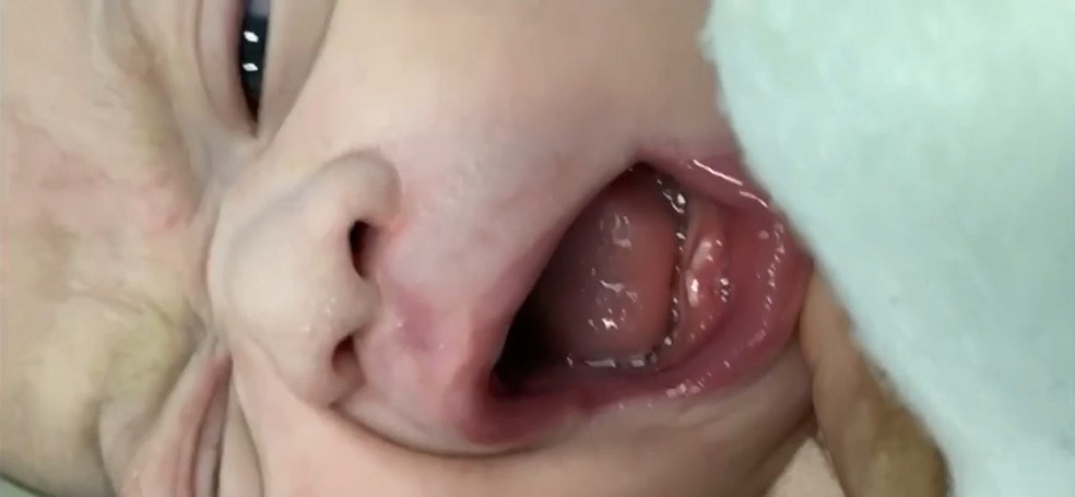 Bebê nasceu com dois dentinhos em hospital de Governador Valadares — Foto: Reprodução/Inter TV dos Vales