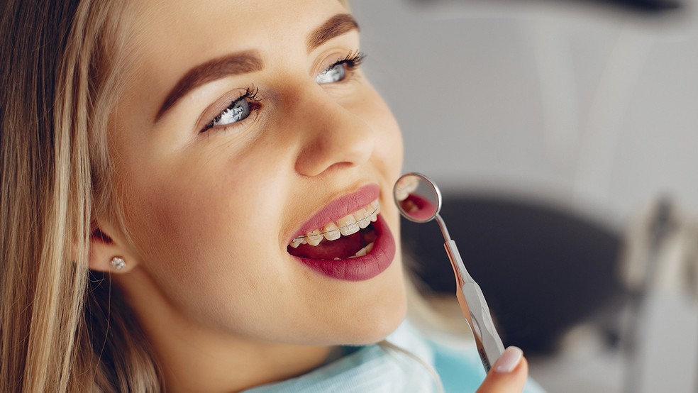 Aplicativo Que Bota Aparelho Nos Dentes Aparelho Nos Dentes Pode Resolver Diferentes Problemas De Saude