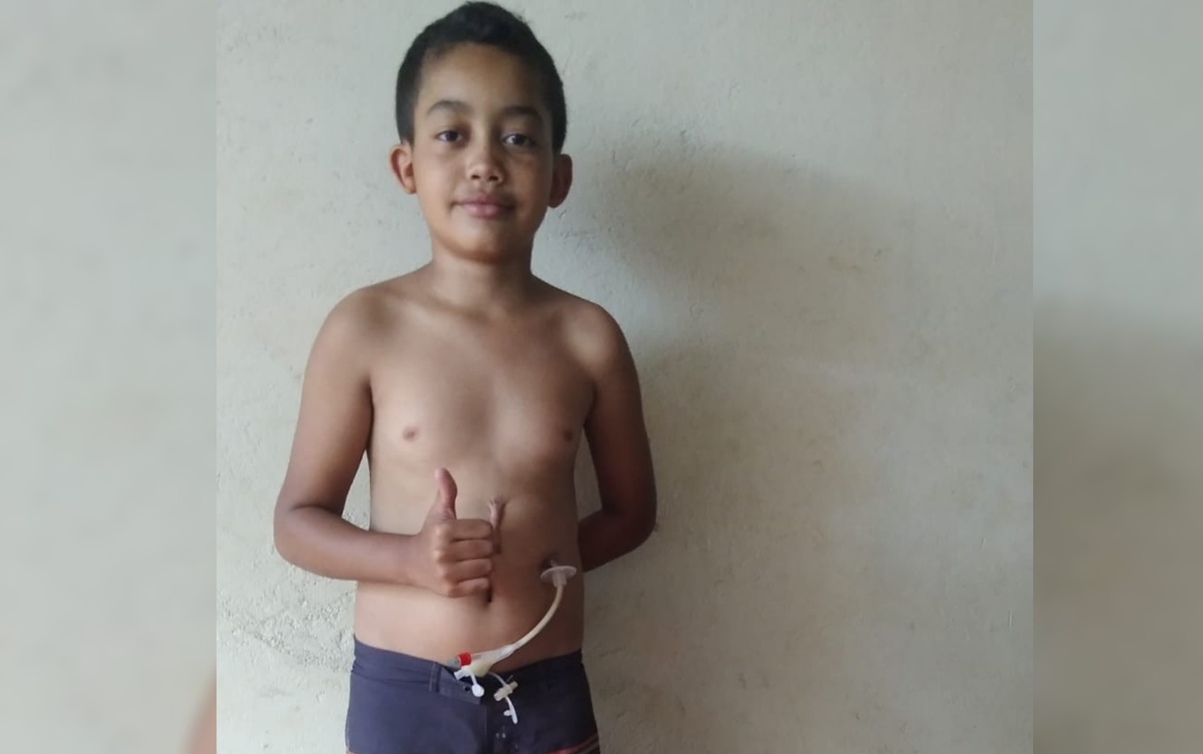 Mãe luta para conseguir cirurgia para filho que sofreu lesão no esôfago após ingerir soda cáustica: 'Só se alimenta por sonda'