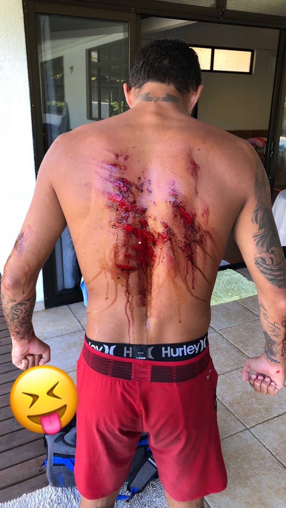Filipe Toledo com uma ferida gigantesca nas costas (Foto: Reprodução/Instagram)