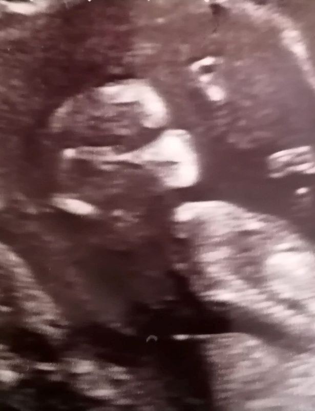 No ultrassom, bebê parece usar máscara (Foto: Reprodução/Mirror)