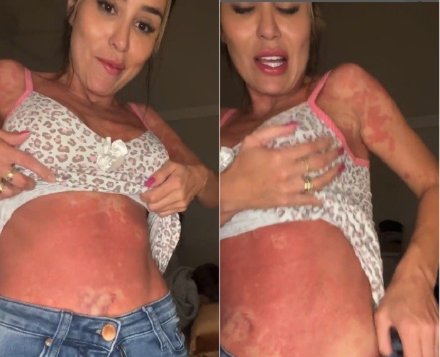 Letícia Santiago mostra manchas pelo corpo (Foto: Reprodução/Instagram)