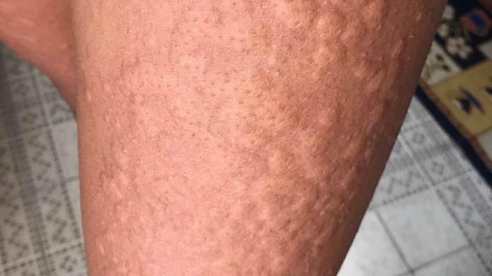 Homem E Atacado Por Aranha Ao Vestir Roupa E Tem Reacao Alergica No Maranhao Maranhao G1