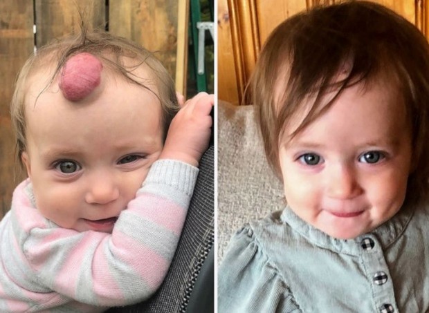 Menina de 1 ano remove grande tumor da testa (Foto: Reprodução Good Morning America)