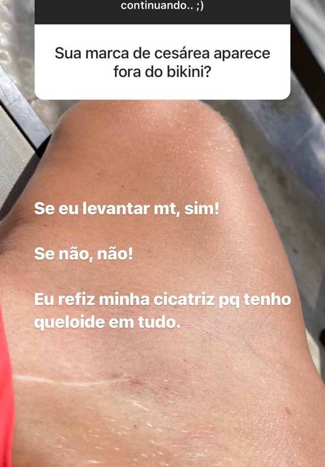 Adriana Sant‘Anna mostra cicatrizes que tem no corpo (Foto: Reprodução/Instagram)