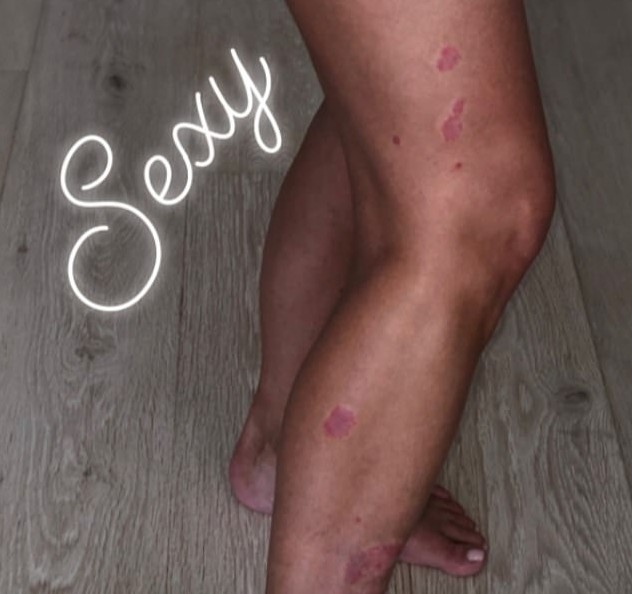 As pernas da socialite Kim Kardashian com as várias marcas de psoríase (Foto: Instagram)
