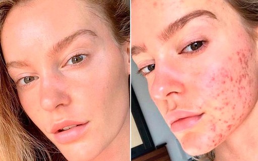 Modelo inspira seguidores ao expor mudança em seu rosto por conta de acne  severa - Monet | Notícias