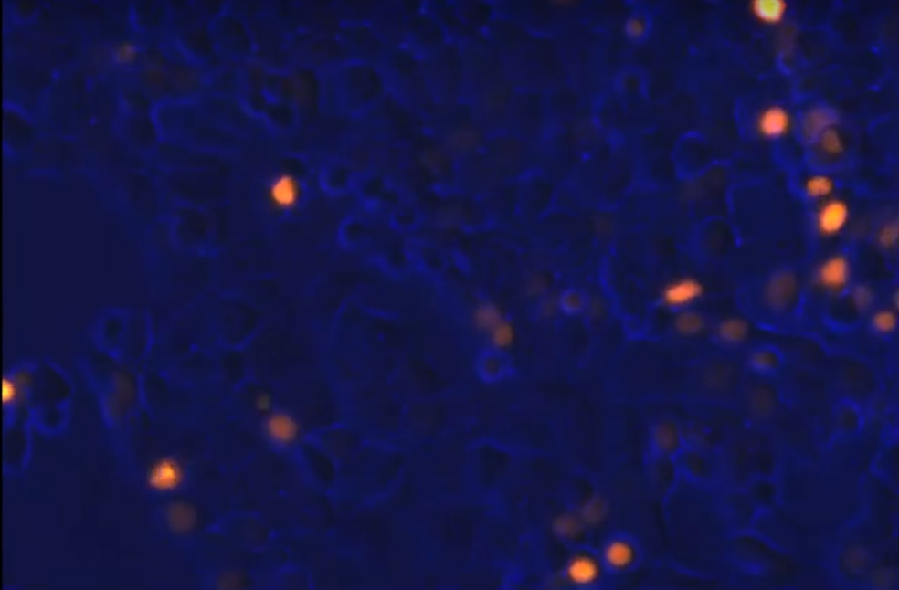 Imagem mostra células do câncer de mama antes do tratamento com a droga-alvo no câncer de pulmão. As estruturas em vermelho indicam células do câncer criadas por um defeito na enzima E-Cadherin  (Foto: ICR/Reprodução)