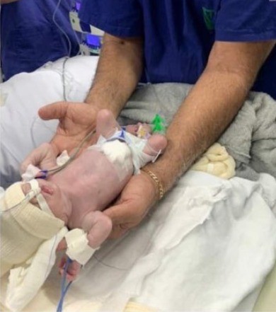 Diagnosticado com estenose pulmonar, bebê prematuro passa por cirurgia rara no coração em Uberlândia