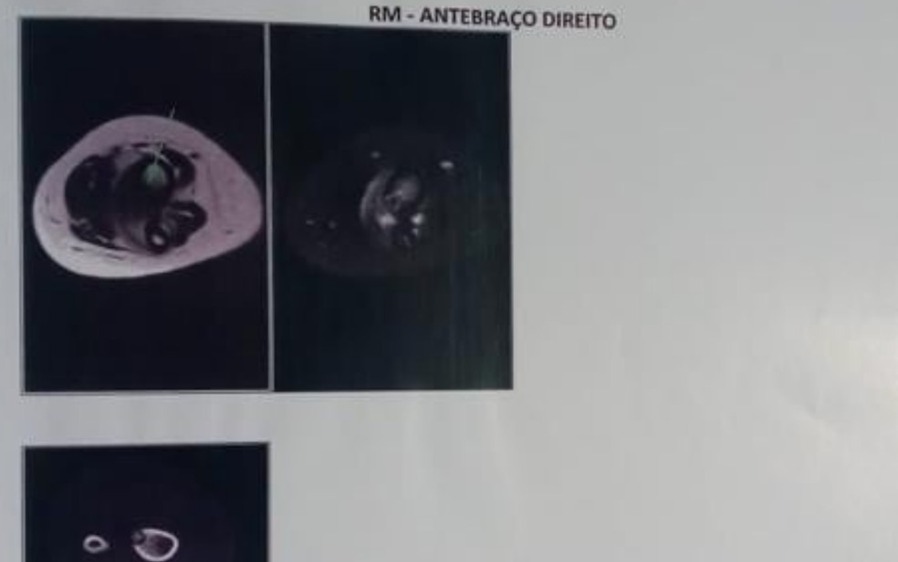 Ressonância magnética que mostra tumor ósseo no antebraço direito de criança que precisa de cirurgia em Goiás — Foto: Mariane Pereira/Arquivo pessoal