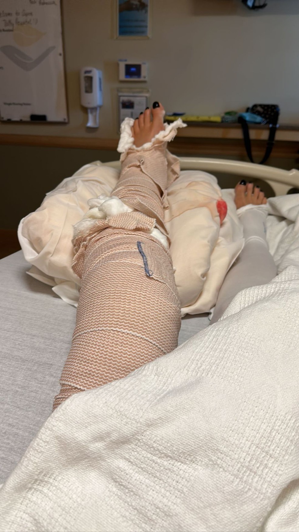 Luciana Gimenez com a perna mobilizada — Foto: Reprodução/Instagram