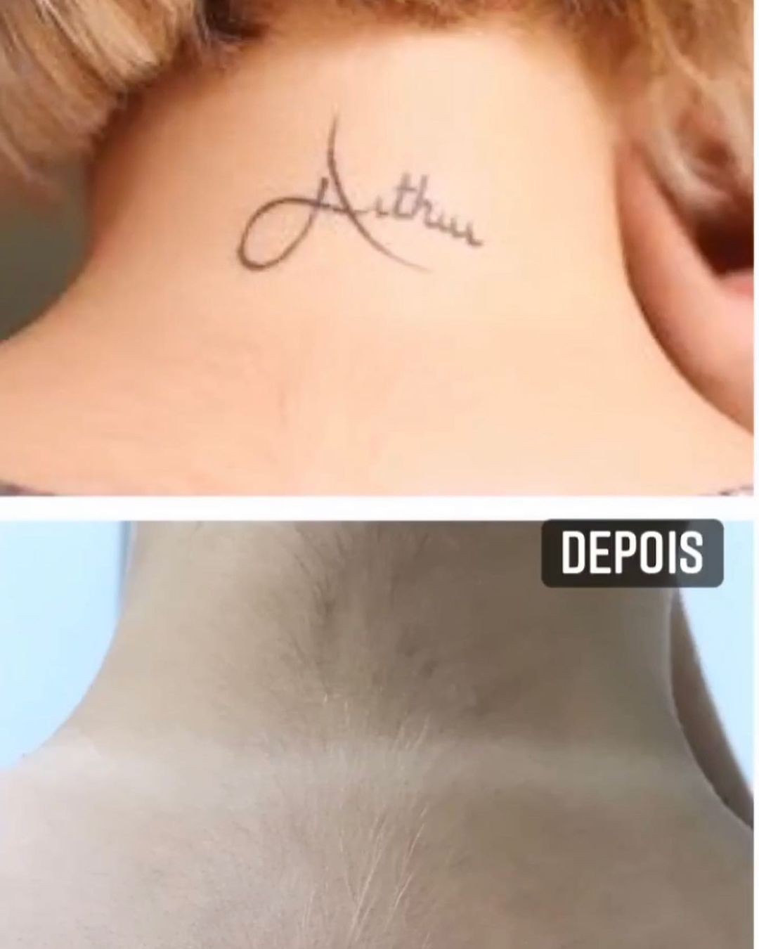 Andressa Urach mostra antes e depois de tirar tatuagens (Foto: Reprodução/Instagram)