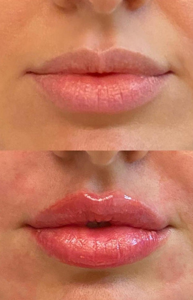 Patricia Leitte mostra antes e depois de preenchimento labial (Foto: Reprodução/Instagram)