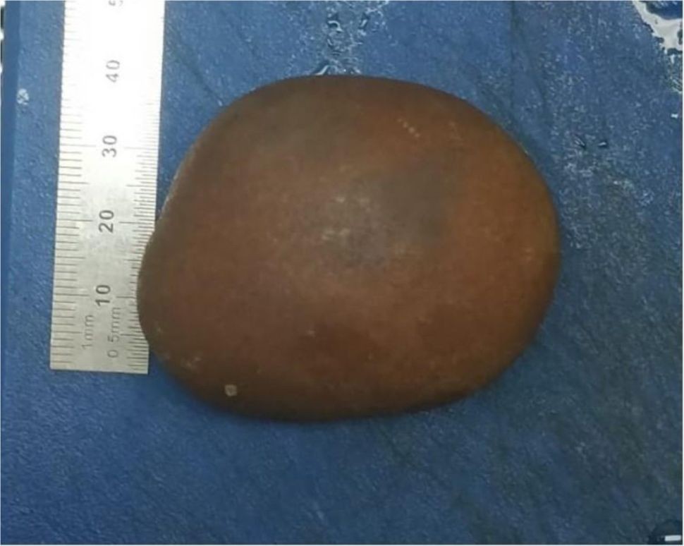 Mulher desenvolve pedra no intestino 60 anos depois de passar por cirurgia na infância (Foto: © BMJ Case Reports 2020)